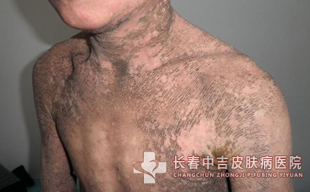 鱼鳞病危害