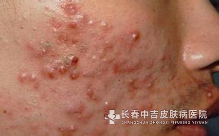 痤疮处理不当会给皮肤造成哪些伤害?