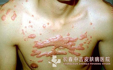 瘢痕患者在治疗后应如何进行针对性护理