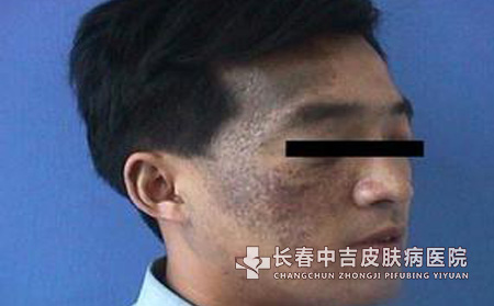 太田痣治疗之后需要注意哪些问题?