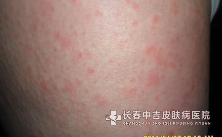造成患者全身皮肤瘙痒的原因
