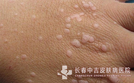 患者需要了解扁平疣的病因来自于哪里