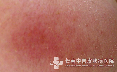 皮肤过敏