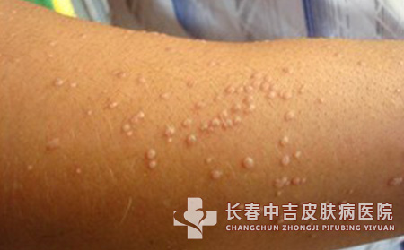 患者不能轻易迈入扁平疣治疗误区里面