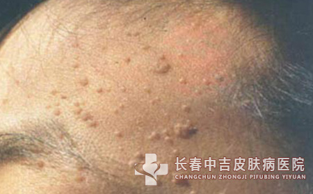 扁平疣患者在预防时应多哪几个方面去注意