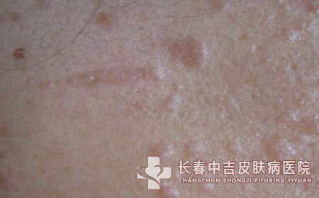 扁平疣病人日常护理应注意个人问题