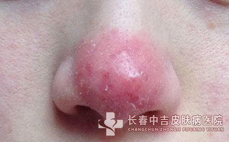 酒糟鼻症状