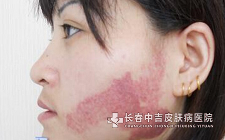 激光治疗鲜红斑痣的相关介绍