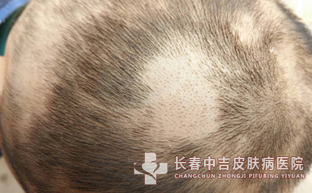 斑秃到底是因为什么而引起的
