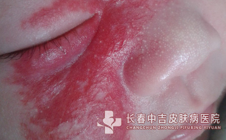 血管瘤危害