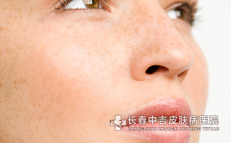 预防雀斑,雀斑患者,雀斑预防