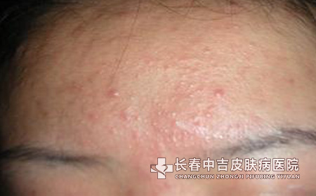 出现痤疮之后应该如何护理加以改善?