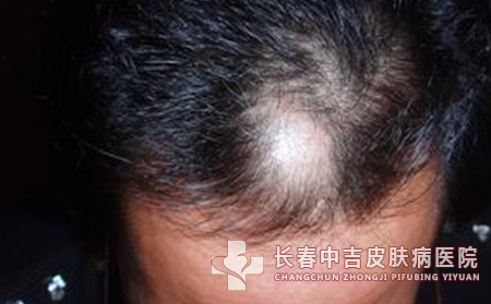 长春斑秃患者日常预防要怎么做