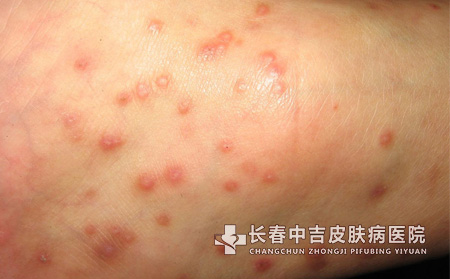 长春治疗湿疹使用激素合适吗?