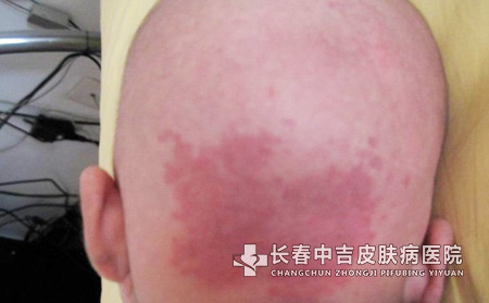 长春鲜红斑痣产生的原因是什么呢?