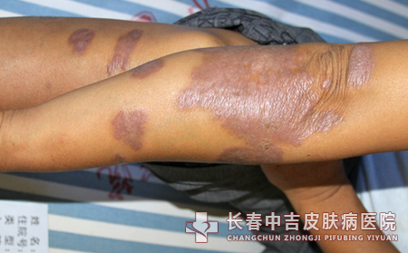 牛皮癣治疗,牛皮癣患者,牛皮癣