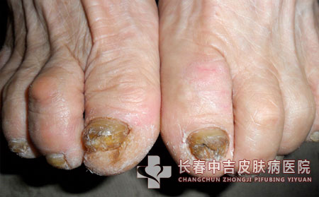 长春灰指甲症状表现常有哪些