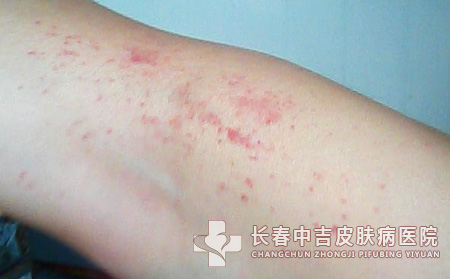 皮肤瘙痒