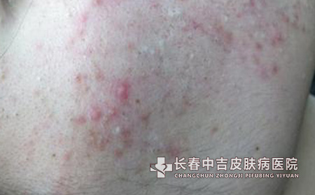 长春女性经期如何护理痤疮问题?