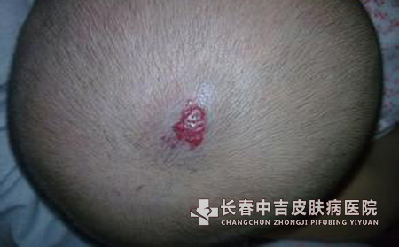 长春血管瘤和鲜红斑痣的区别是什么?