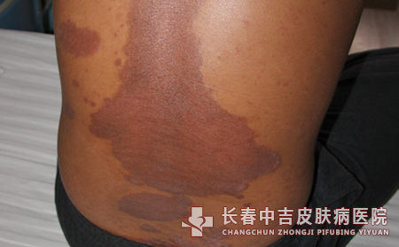 长春牛皮癣患者的治疗需要注意什么问题?