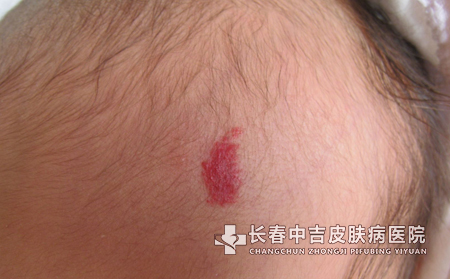 胎记治疗在长春看病费用贵不贵