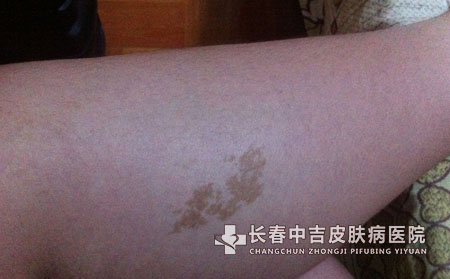 胎记长春治疗价格一般人能承受吗