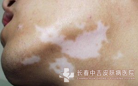 白癜风症状