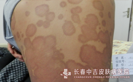长春临床常见的牛皮癣诱因有哪些?