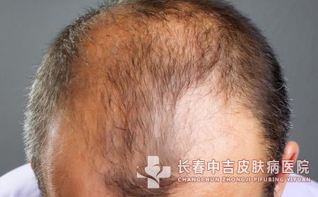 脱发病因,脱发,脱发患者