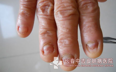 灰指甲病因