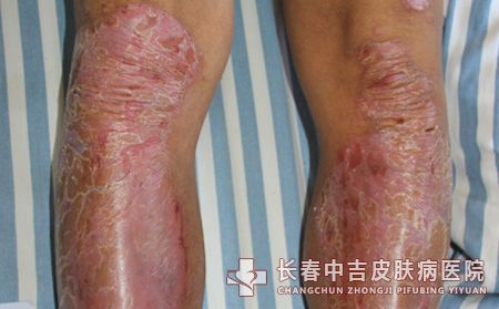 长春皮肤病医院介绍预防牛皮癣出现的方法