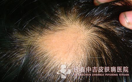 斑秃护理
