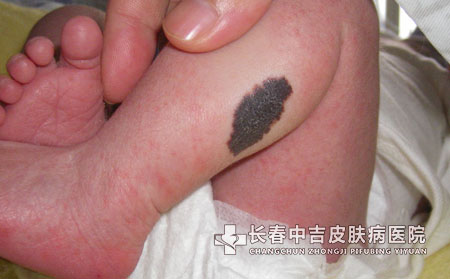 长春治疗胎记医院哪里合适