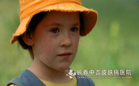 长春为什么会出现雀斑呢?