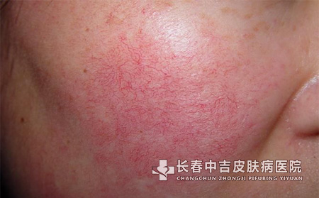 长春传统的红血丝治疗方法是什么?