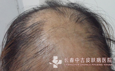 脱发治疗