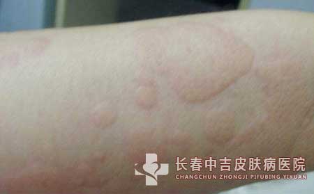 荨麻疹治疗不当的危害有哪些?