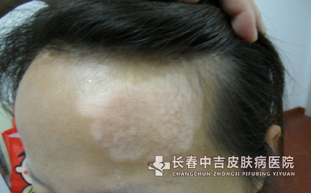 秋季白癜风患者如何科学饮食呢?