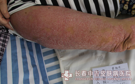 牛皮癣患者需要注意哪些问题?