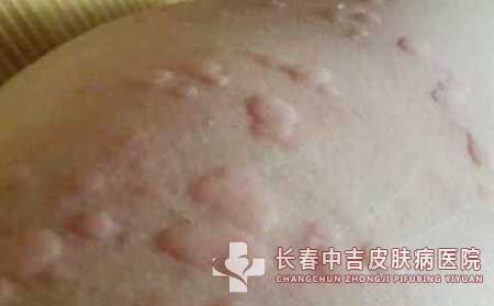 为什么会诱发荨麻疹出现的病因有哪些