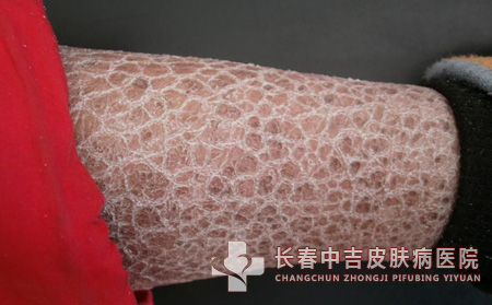 鱼鳞病症状