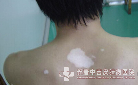 白癜风危害