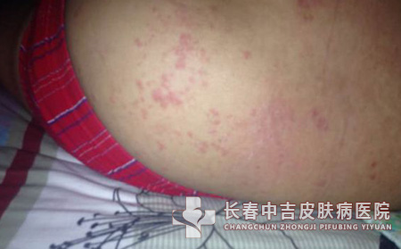 股癣治疗