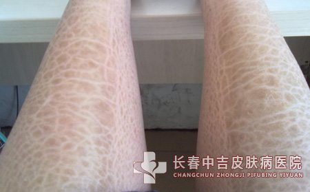 鱼鳞病症状