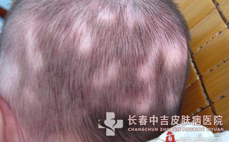 斑秃预防