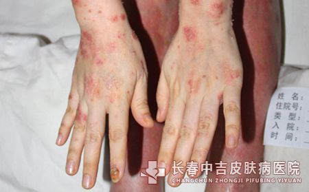 牛皮癣病因