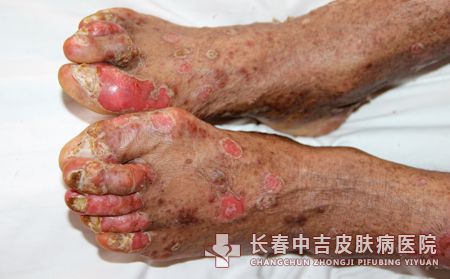 牛皮癣护理