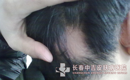 斑秃病因