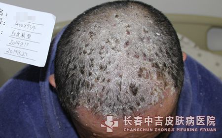 牛皮癣如何护理